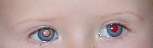 Et hvitt og et rødt øye ved blits hos jente, 2 år - Kropp og helse -  Kvinneguiden Forum