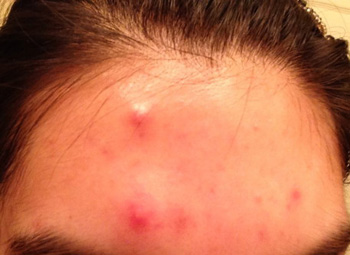 acne3.jpg.513f2604859627a1b6811ed99a9d0690.jpg