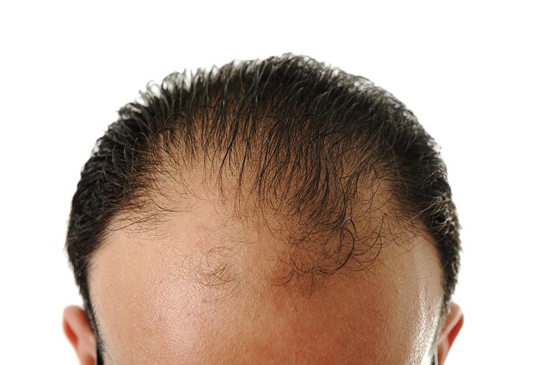 man-loosing-hair-baldness_HFJ-zNSarj-small.jpg.207c6de20af602b4aaddcbed2566491b.jpg