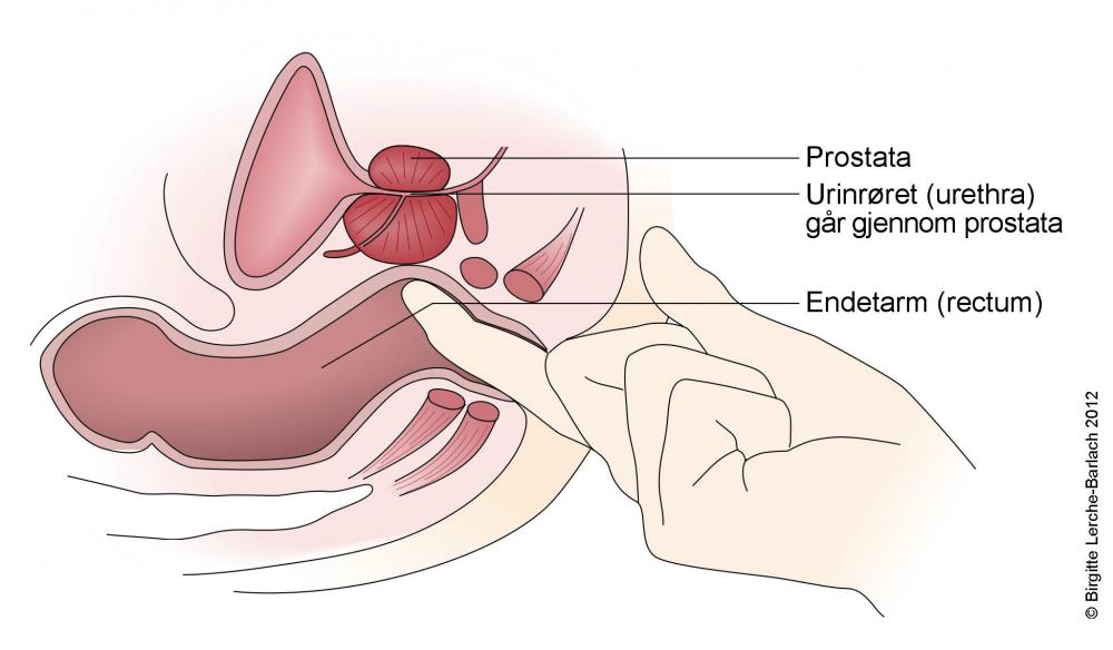 9672-2-id-434-eksploration-af-prostata.jpg