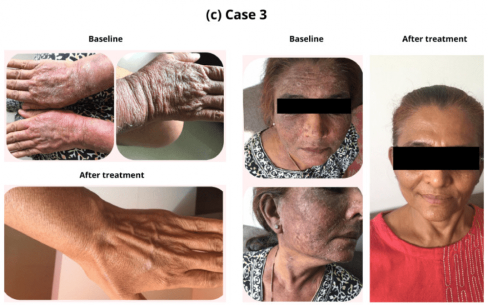 psoriasis-1-1.thumb.png.e1c5b3b9f9cd72b8a951132045a27a68.png