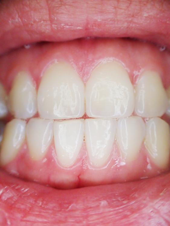 teeth-887338_1920.thumb.jpg.0474dcb3e33b41cca614e77e6d6dbad0.jpg