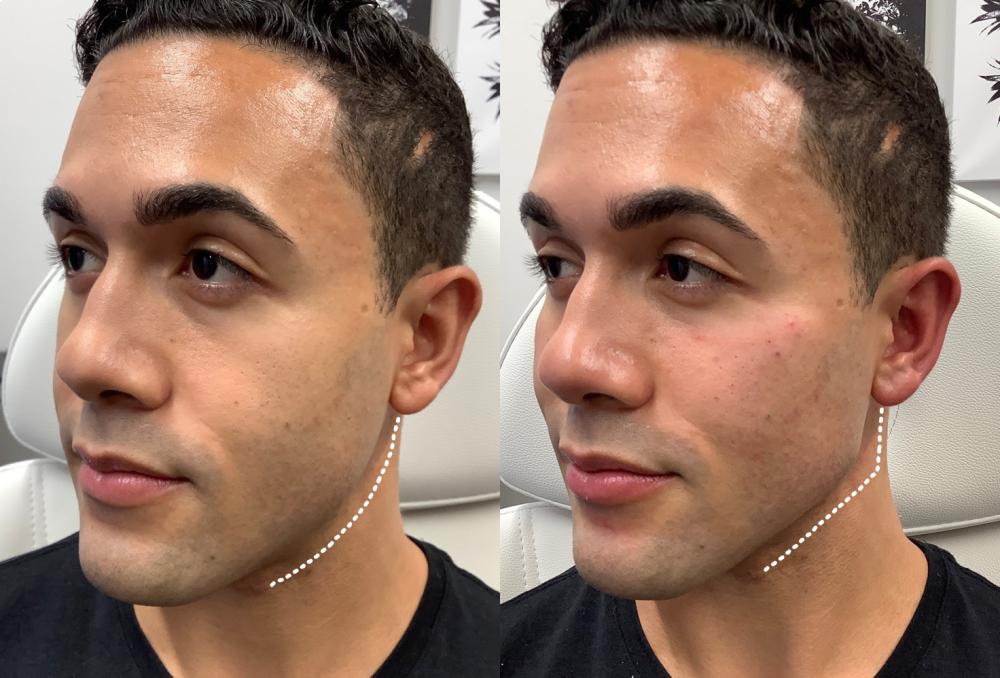 before_after-jawline-filler-immediate-post-injection.jpg