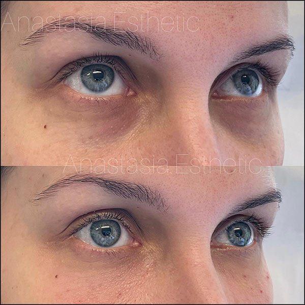 under-eye-filler-pxy308lab5a4tbe8ehc9t6i607tlbuivwmhno85zzk.jpg.4e032a1f1b801a5eac3bc8840c50bf56.jpg