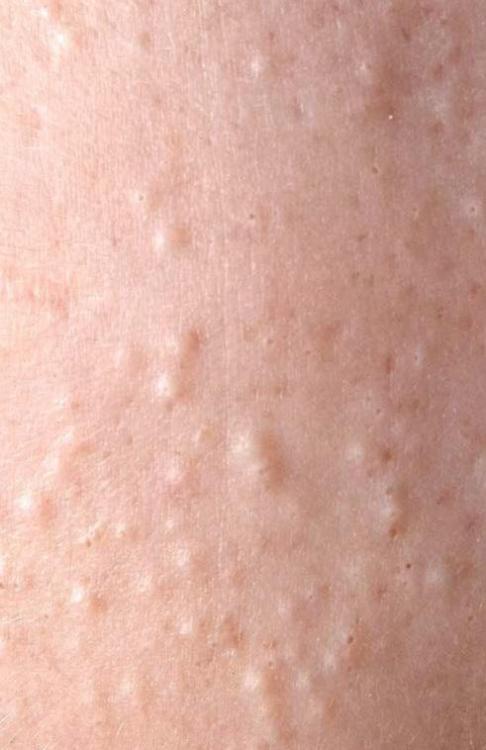 Health-133.acne-001-5569be33e2174af18cc1513bdfa52610.jpeg