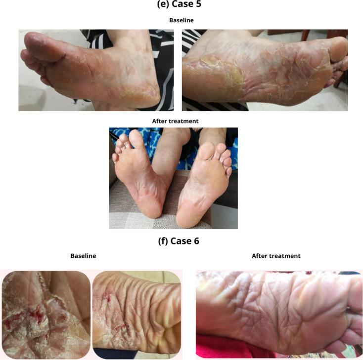 psoriasis.jpg.64d6f25d74e7620df1f6e6103af080da.jpg