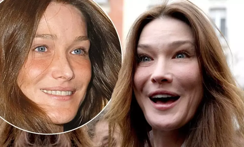 Carla-Bruni-Plastic-Surgery1-1.webp